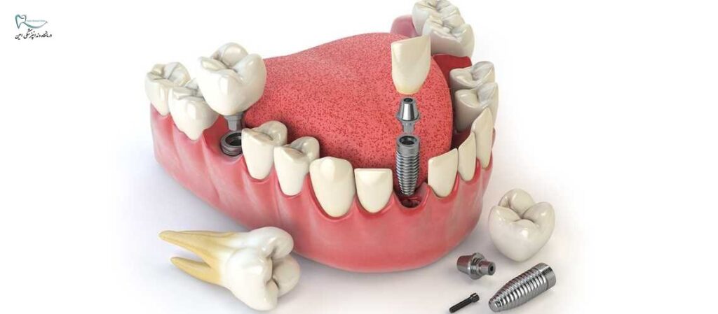 متخصص ایمپلنت دندان شیراز